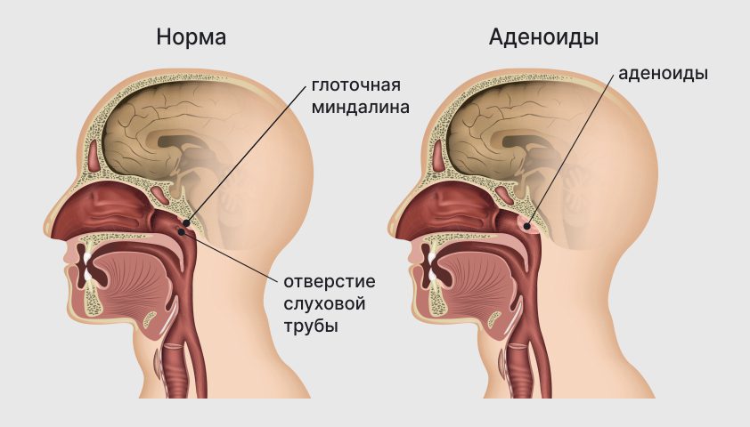 Аденоиды