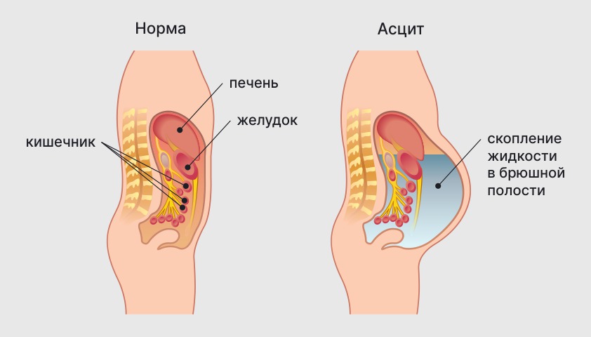 Цирроз печени — стадии, симптомы, лечение и диагностика