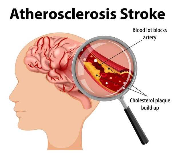 Атеросклероз головного мозга: симптомы, причины и лечение