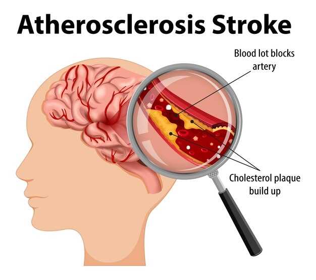 Атеросклероз головного мозга