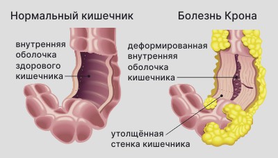 Болезнь-Крона2