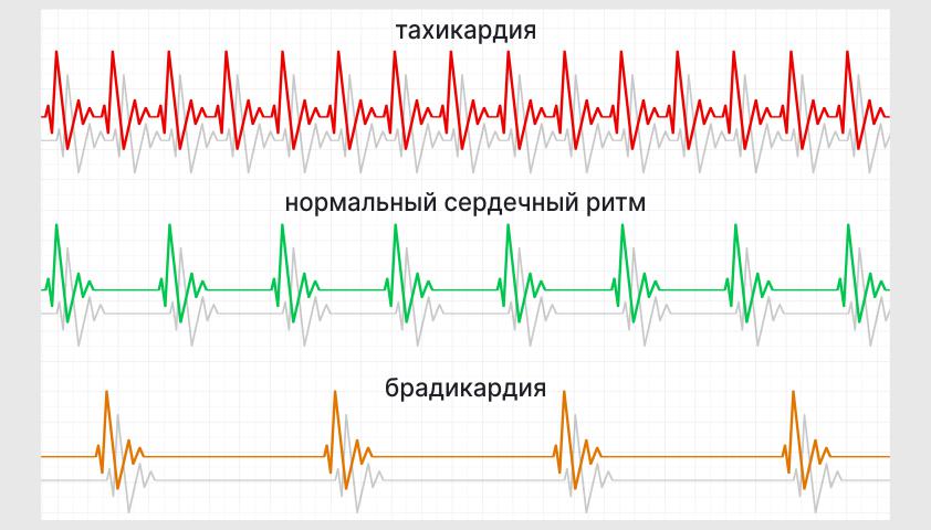 Тахикардия — что это, симптомы и причины возникновения