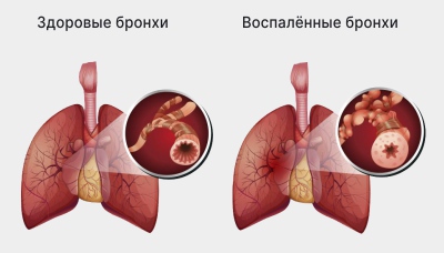Бронхит