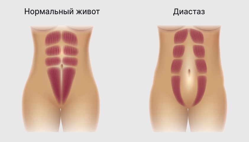 Тянет низ живота при беременности - что делать?