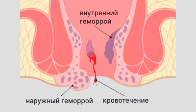 Геморрой у беременных — в 1, 2 или 3 триместре, причины, что делать