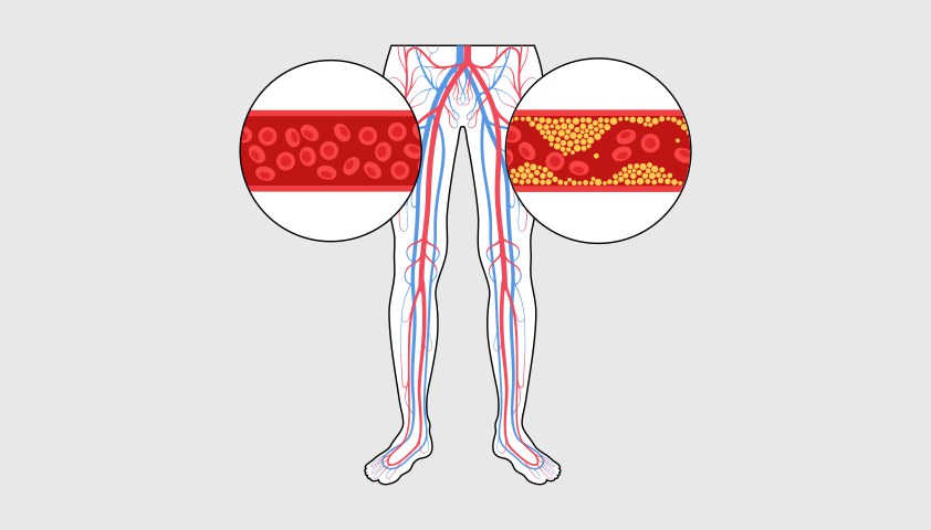 Атеросклероз сосудов нижних конечностей — что это, симптомы и лечение