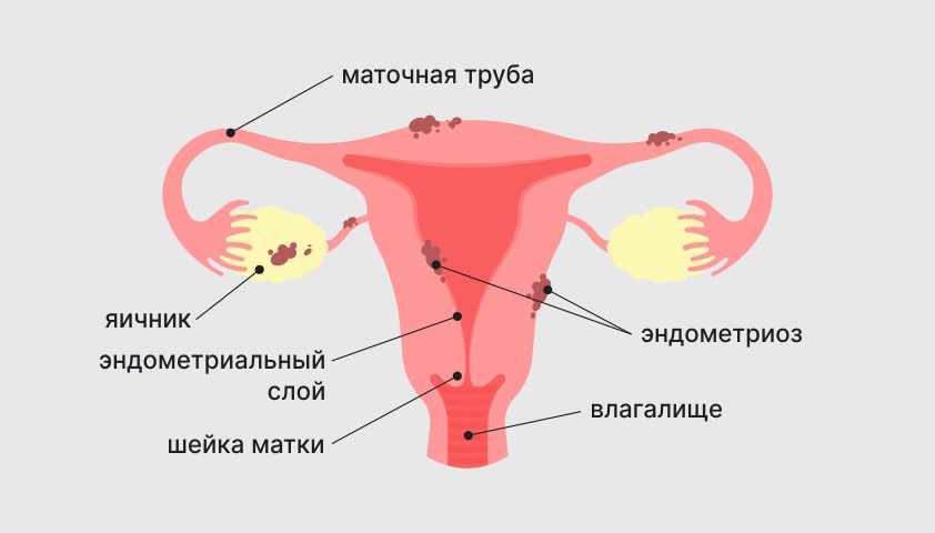 Эндометриоз — что это, причины, симптомы и лечение