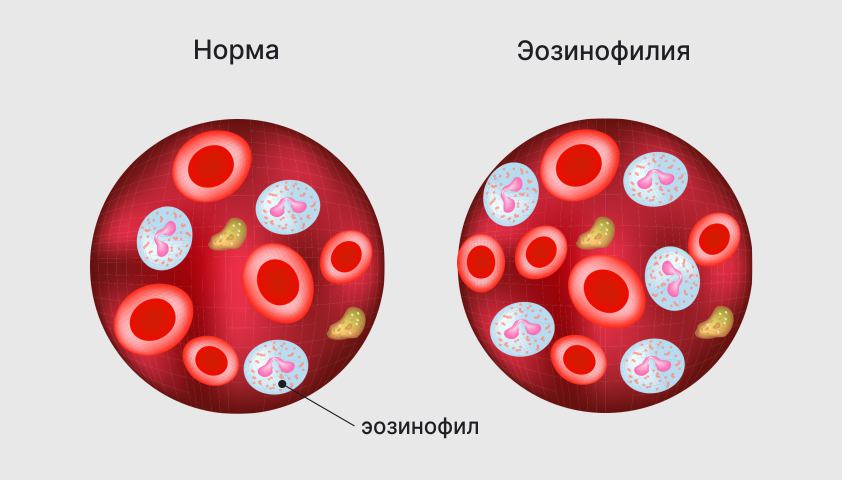 Эозинофилы повышены у взрослого в крови — причины и последствия