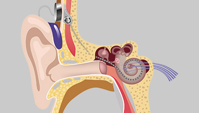 Кохлеарный-имплантат