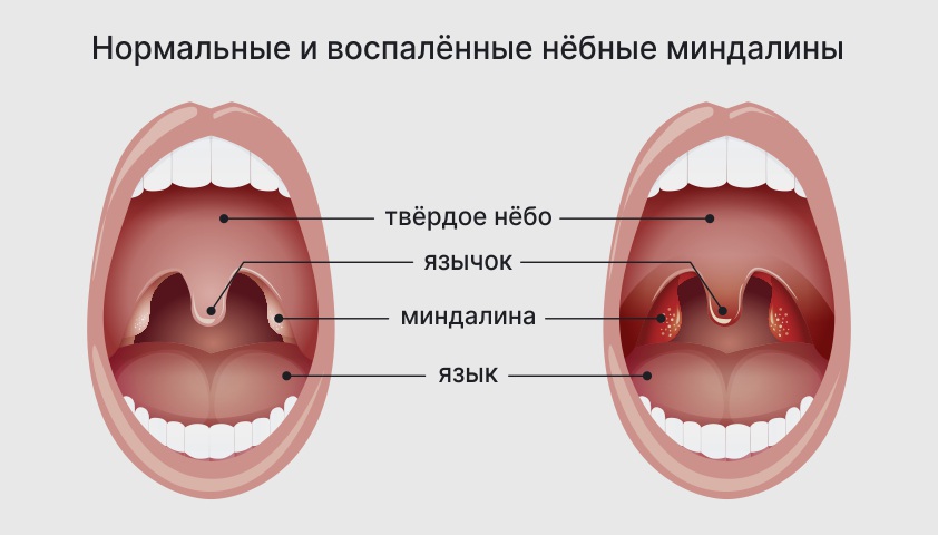 Ангина при беременности - в 1, 2 или 3 триместре, причины, как лечить горло