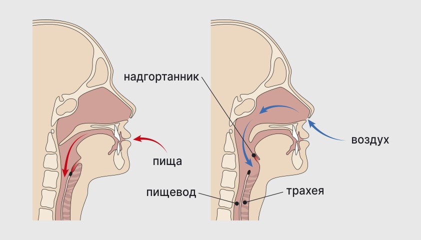 Cиндром Мендельсона – симптомы, профилактика и лечение