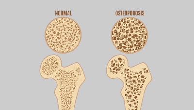 Остеопороз у женщин и мужчин - что это, симптомы и лечение