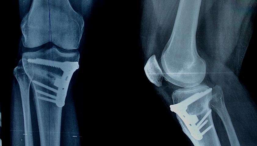 Артроз коленного сустава (гонартроз) — симптомы, степени, диагностика, лечение