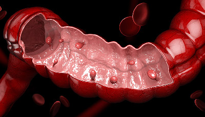 Полипы в кишечнике, полипы в прямой и толстой кишке