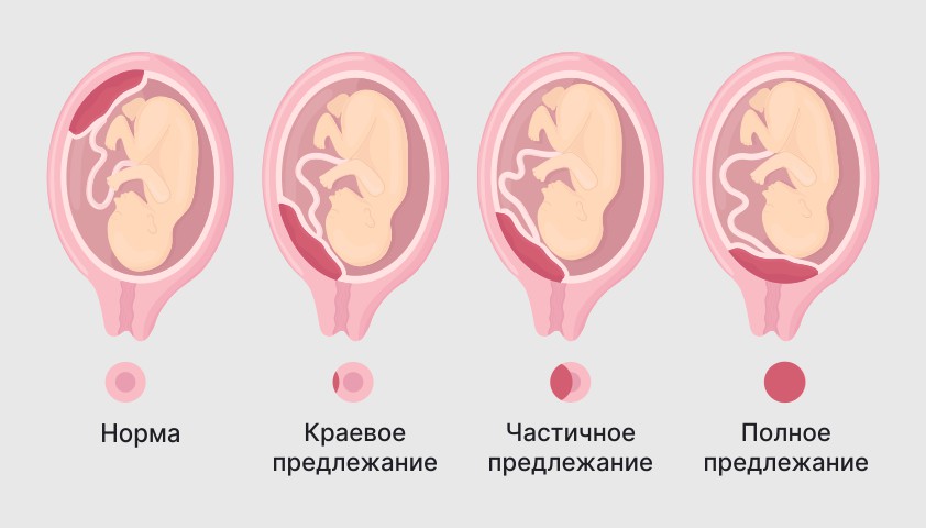 Предлежание плаценты - низкое или полное, причины, что делать