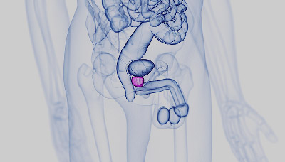Рак простаты — симптомы, признаки и лечение у мужчин