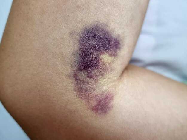 Причины и особенности пятен на теле как кровоподтеки