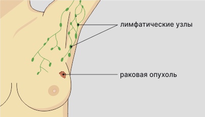 Рак-молочной-железы