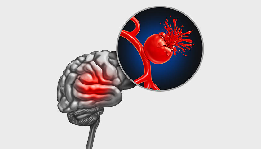 Аневризма сосудов головного мозга - признаки и причины