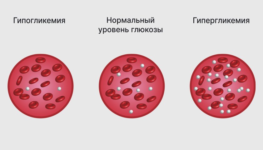 Сахарный диабет 1 типа (инсулинозависимый диабет) — причины и симптомы