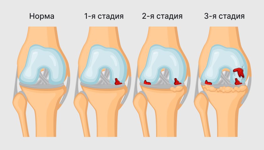 Артроз коленного сустава (гонартроз) — симптомы, степени, диагностика, лечение