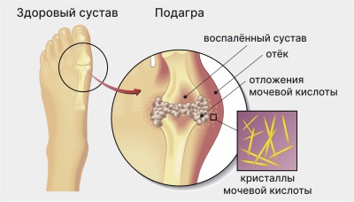 Симфизит -при беременности и после родов - причины и диагностика