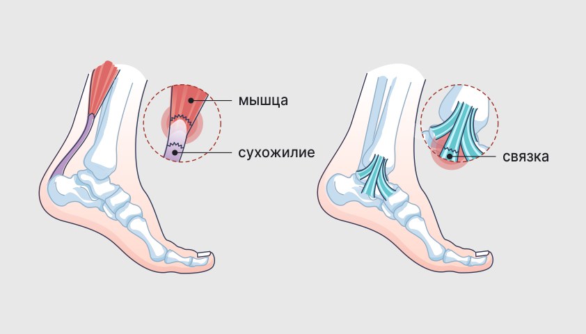 Растяжение связок