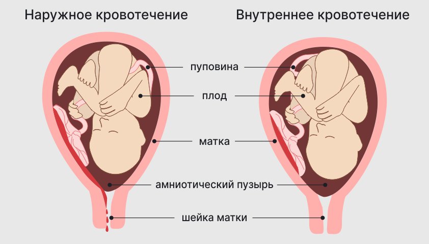 Кровотечение при беременности — в 1, 2 или 3 триместре, что делать