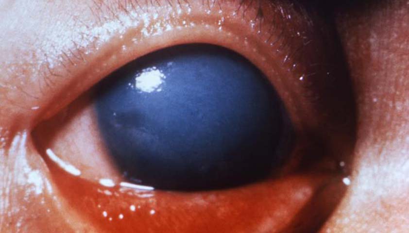 Глаукома - что это, симптомы, признаки и лечение