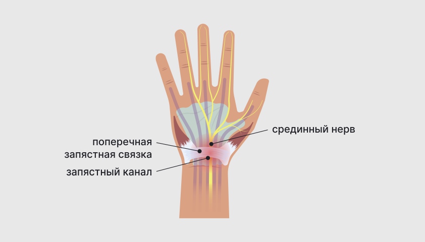 Синдром запястного канала (карпальный туннельный синдром)