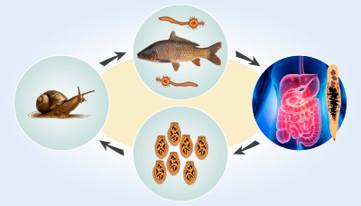 Описторхоз — симптомы и лечение, что нельзя есть при описторхозе
